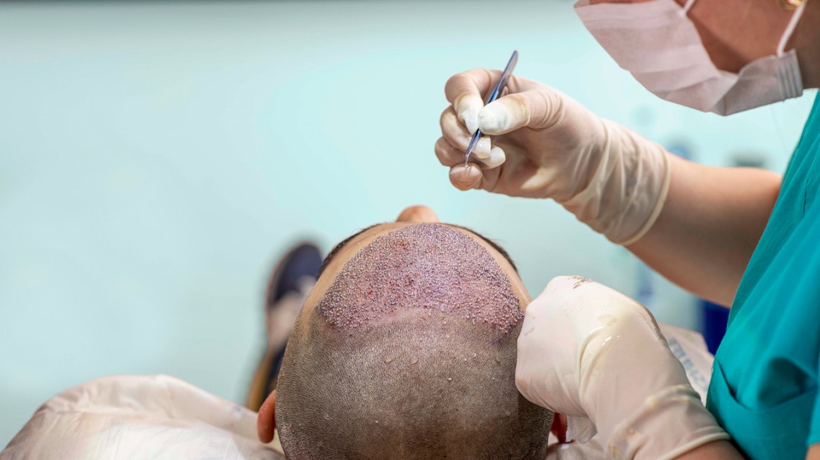 What Makes FUE Hair Transplants So Important