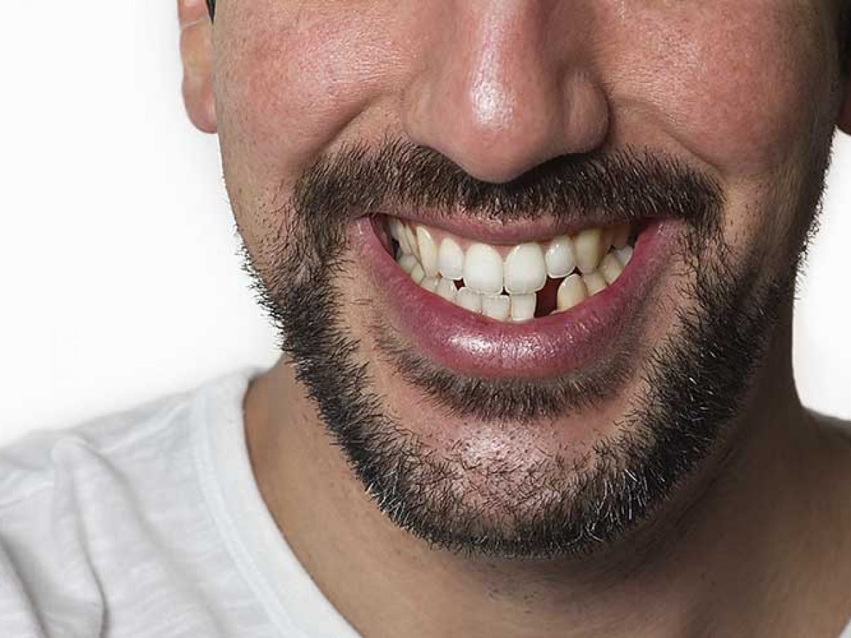Have You Lost A Tooth? Here Are Tooth Replacement Options You Can Take Advantage Of