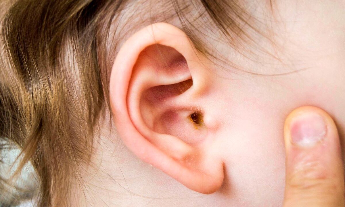 Things to know about the ear syringing treatment Ultra Medica