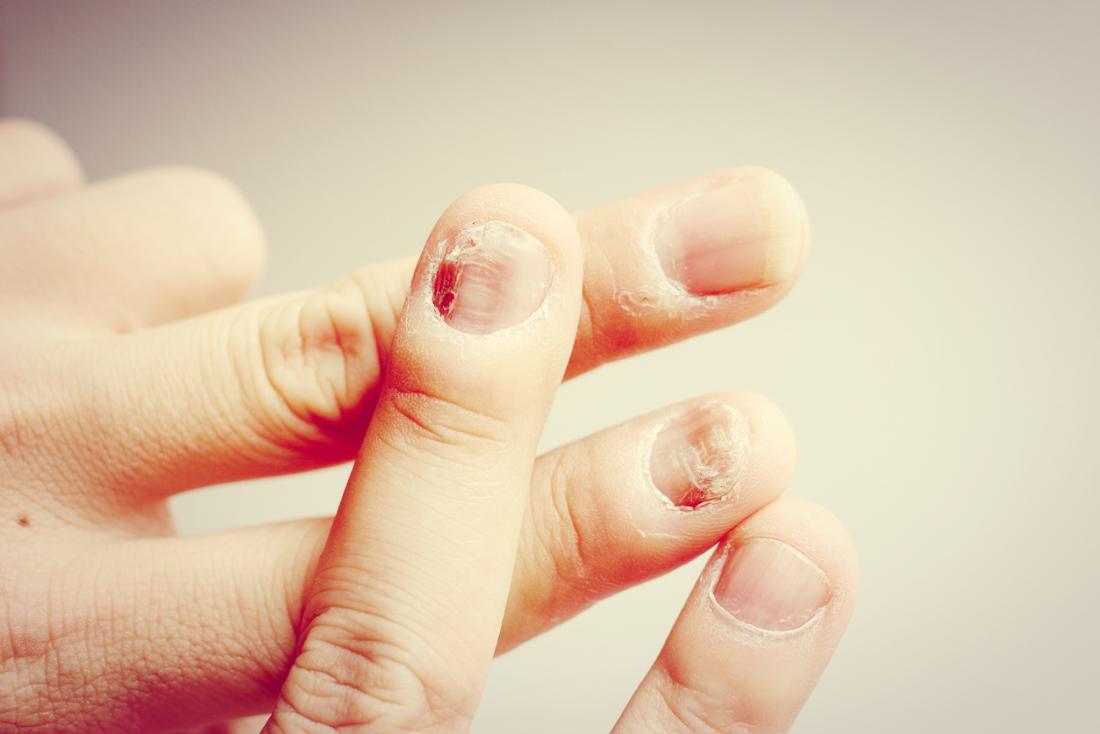 Nail Infections: Causes, Symptoms and Treatment Options