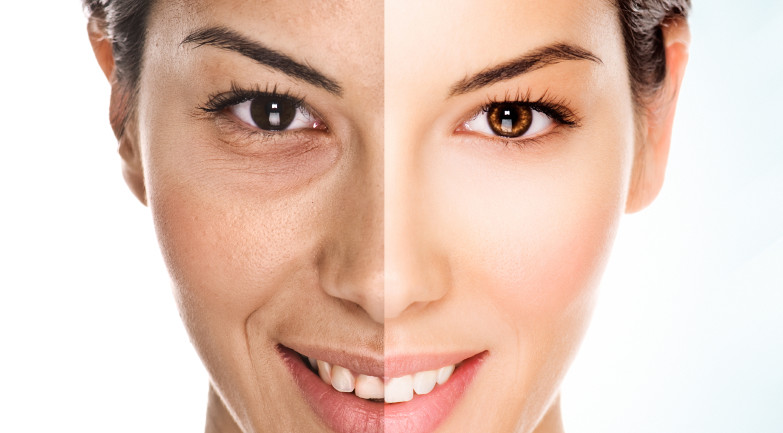 Understanding How Facial Fat Transfer Works