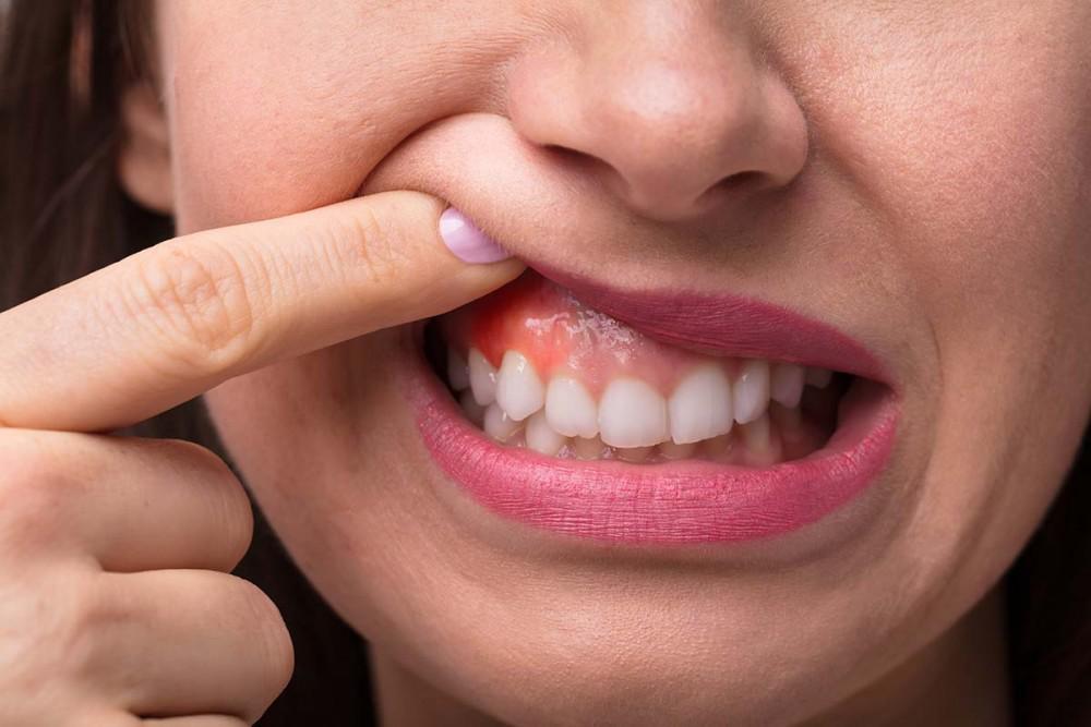How You Can Prevent Gum Swelling