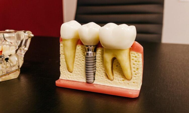 Dental implants to replace missing teeth.docx
