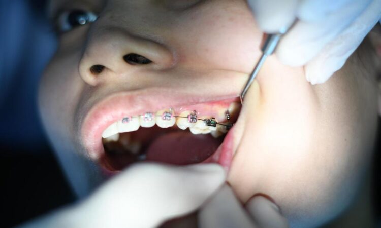 Top tips for maintaining fitted braces.docx