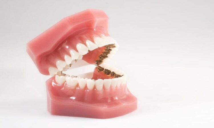 Understanding lingual braces a hidden revolution in adult orthodontics.docx