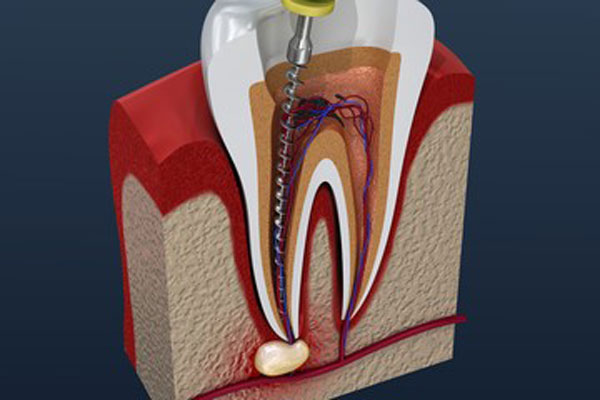 The Connection With Root Canal