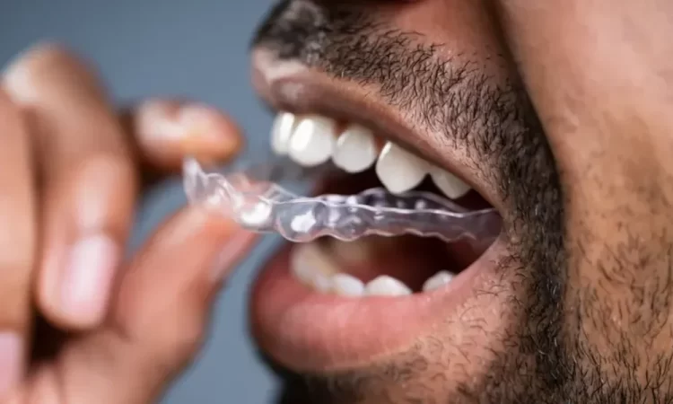 Navigating Invisalign