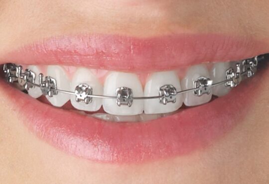 orthodontic treatment