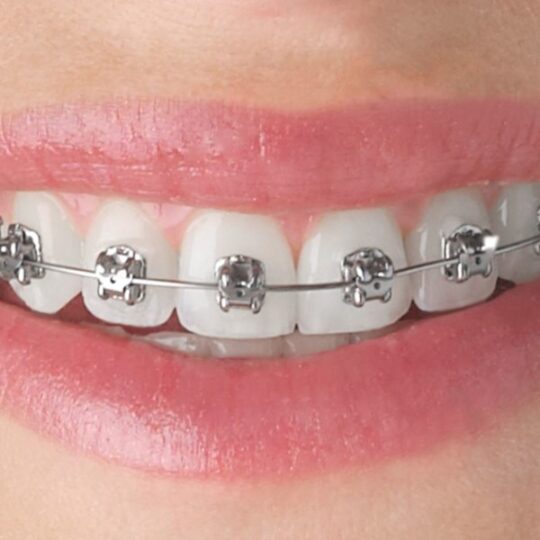 orthodontic treatment