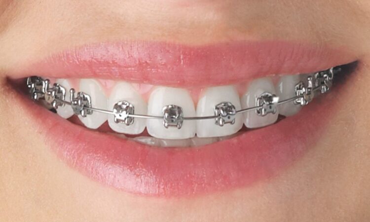 orthodontic treatment