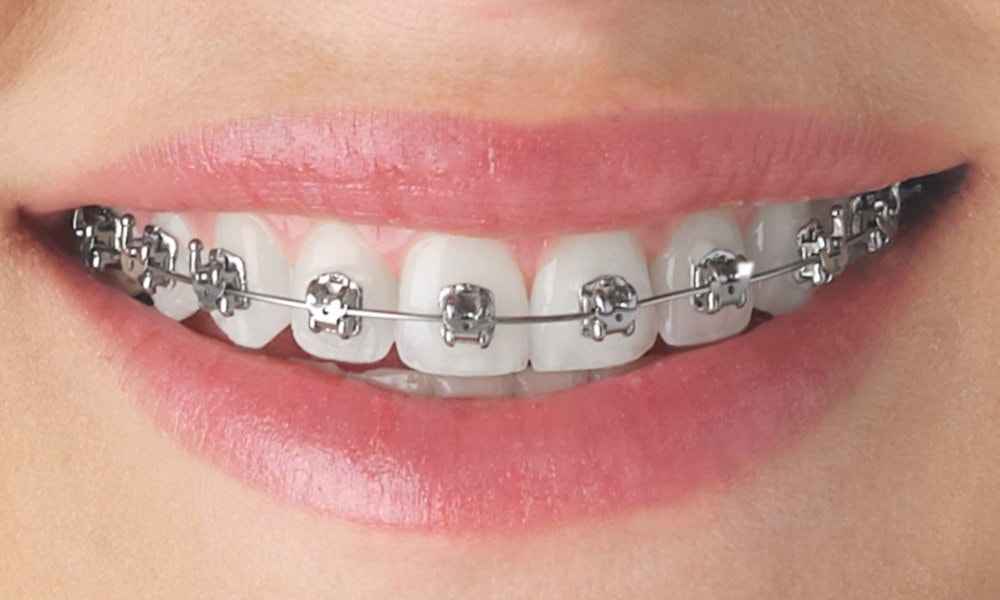 Why Orthodontic Treatment Takes Time: The Biology Behind