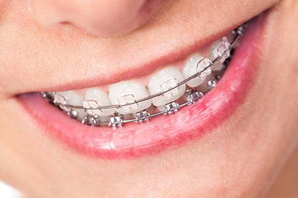 orthodontic treatment