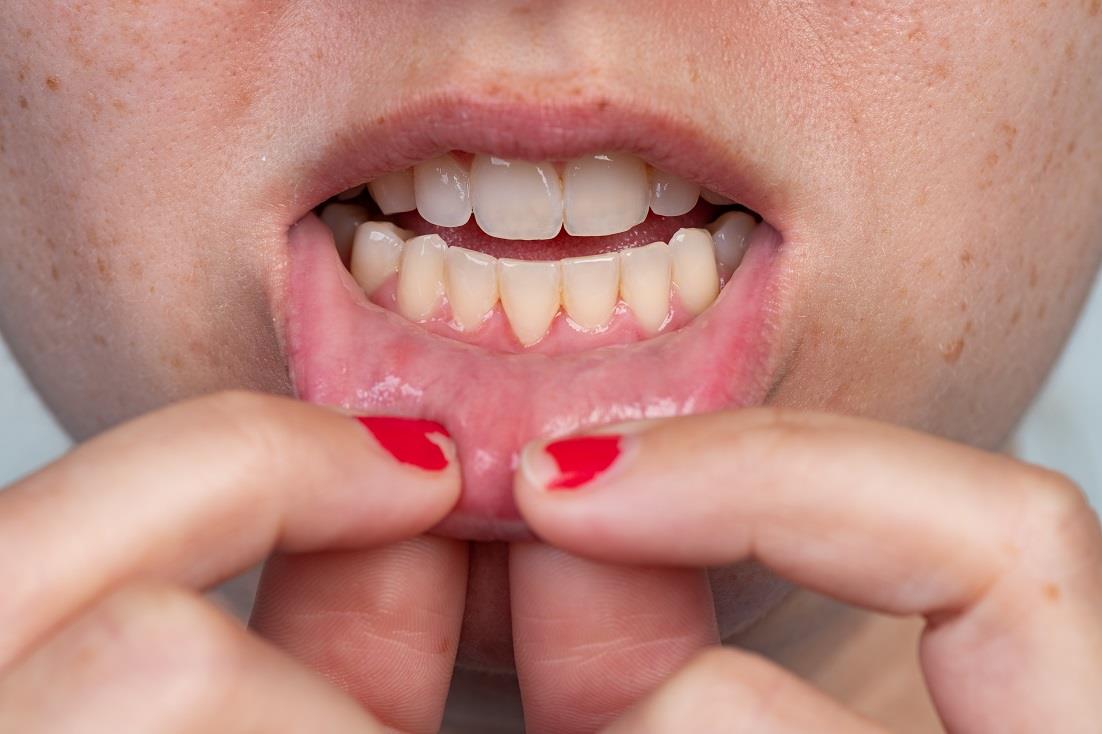 Understanding How to Manage Gum Recession: Causes and Treatments